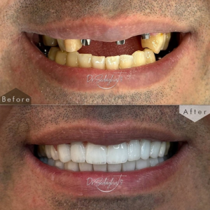 لمینت دندانپزشکی