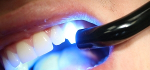 پرکردن با مواد همرنگ دندان در دندانپزشکی درین
