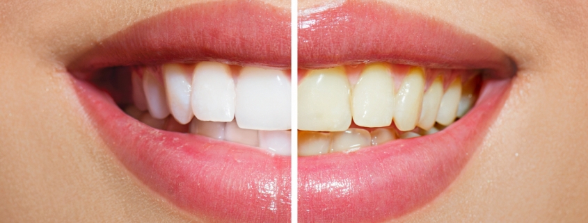 سفید کردن دندان در دندانپزشکی درین