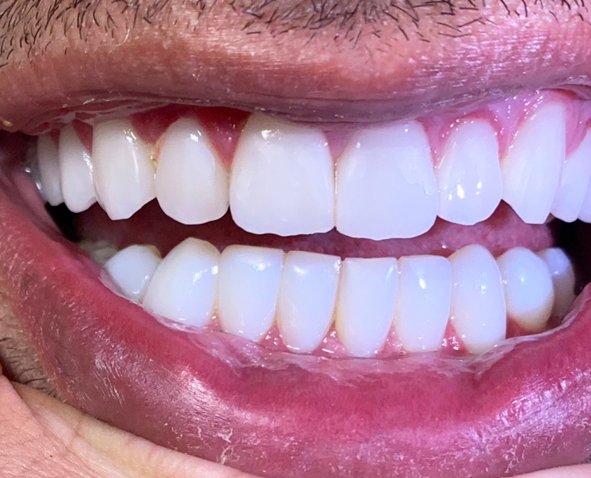 درمان زیبایی دندان