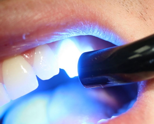 دندانپزشکی کامپوزیت