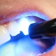 دندانپزشکی کامپوزیت