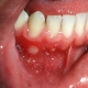 زخم آفت دندانپزشکی درین تجریش