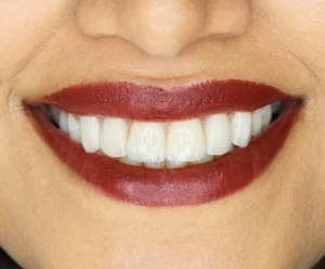 لمینیت-دندانپزشکی-زیبایی