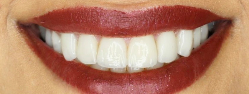 لمینیت-دندانپزشکی-زیبایی