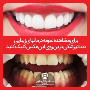 نمونه درمان زیبایی دندانپزشکی درین تجریش