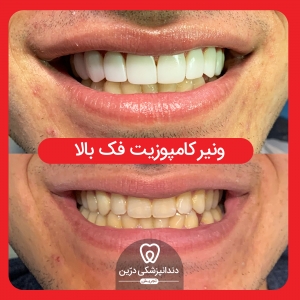 لمینیت زیبایی دندان تهران