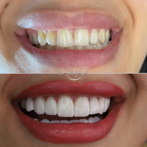 porcelain laminate veneer teeth dentist