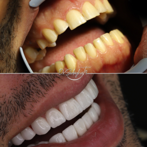 laminate porcelain veneer teeth dentist